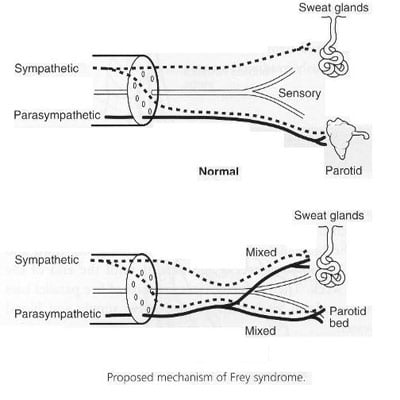 Frey's Syndrome Treatment