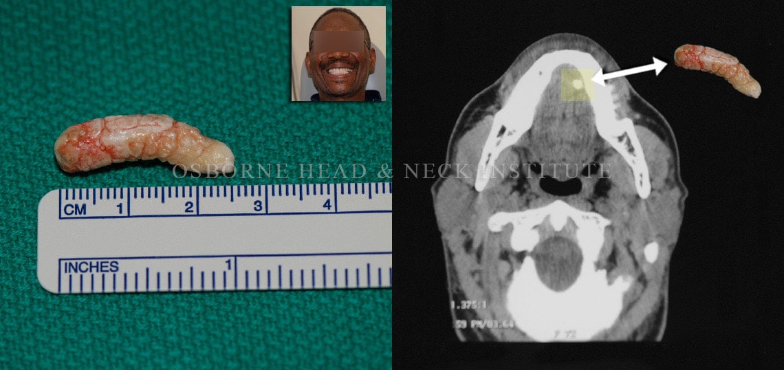 Sialendoscopy For Salivary Gland Stone Treatment